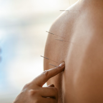 Acupuncture on woman's back.